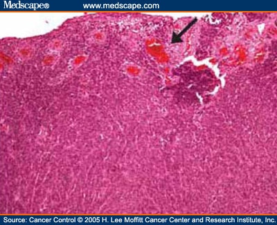 melanoma ulceration pathology outlines superficial spreading