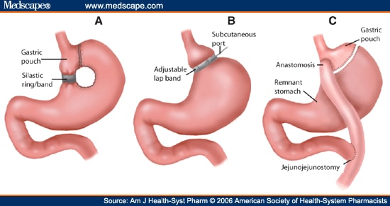 Topamax For Neuropathic Back Pain