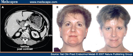 42+ Frau cushing syndrom bilder , survive the journey Cushing&#039;s Syndrome in Women With Polycystic