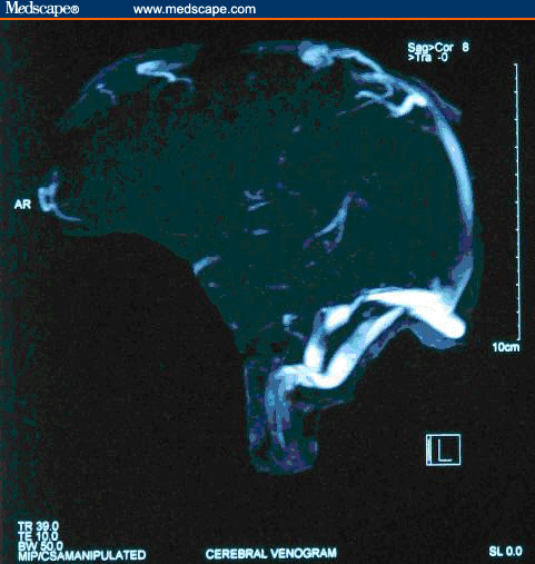 picture of a fibroid sitting bilaterally
