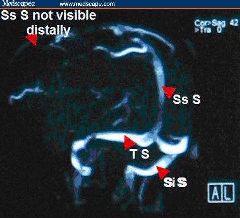 Please note: in Figures 2 and 3, Ss S= Superior sagittal sinus, 