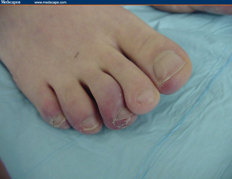 Superficial Frostbite Toes