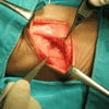 Figure 3: Right muscle-spearing thoracotomy