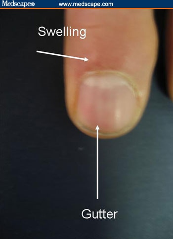 A mucous or myxoid cyst is a collection of degenerative collagen that can A mucous or myxoid cyst is a collection of degenerative collagen that can