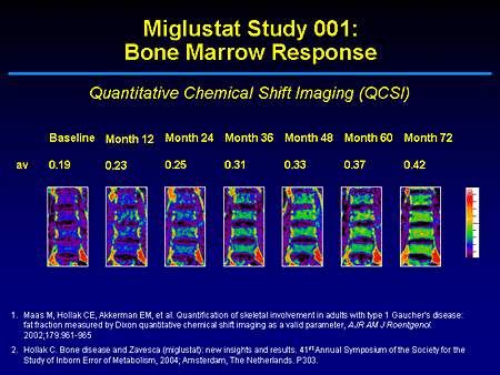 Miglustat Study 001: Bone Marrow Response