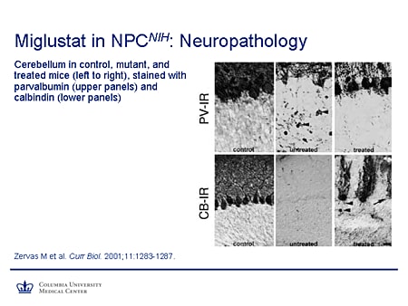 Miglustat in NPCNIH: Neuropathology