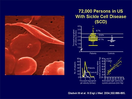 72,000 Persons in US With Sickle Cell Disease (SCD)