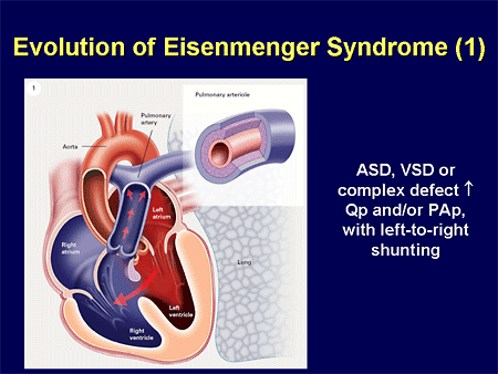 Evolution of Eisenmenger Syndrome (1)