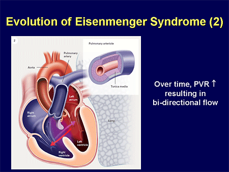 Evolution of Eisenmenger Syndrome (2)