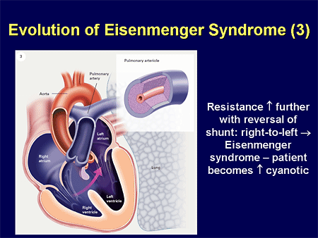 Evolution of Eisenmenger Syndrome (3)