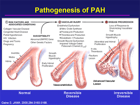 Pathogenesis of PAH