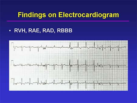 Findings on Electrocardiogram