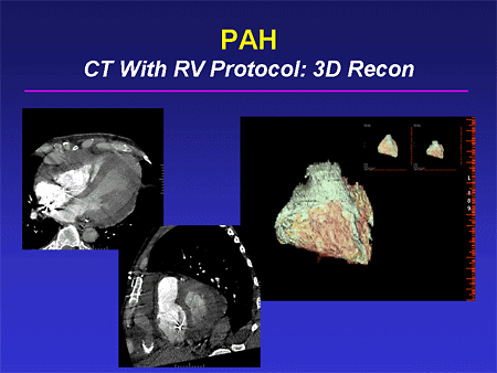 PAH: CT With RV Protocol: 3D Recon