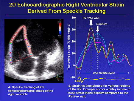 2D Echocardiographic Right Ventricular Strain Derived From Speckle Tracking
