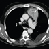 Figure 1: A CT scan of the chest. The image shows a 5 × 8 cm mass (arrow) in the anterior segment of the left upper lobe and a left-sided pleural effusion with septa.