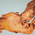 Figure 2: Excised pseudotumor. A solid pseudotumor measuring 4.5 × 3.5 × 3.0 cm, which was partly contained within the lung and was partly within the adherent fatty and connective tissue, was resected.