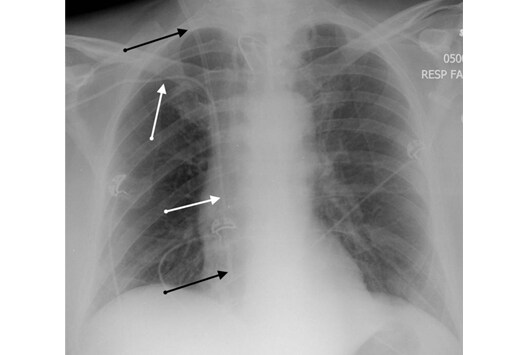 Internal Jugular Line