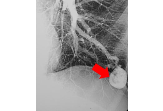 One third of patients with