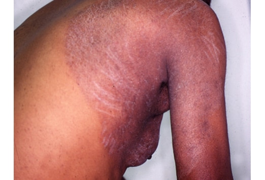 skin folds rash