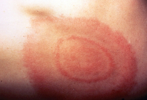 Target Lesion Lyme