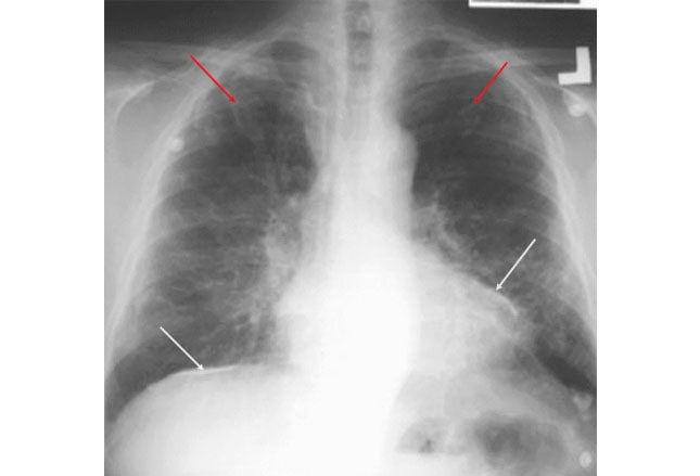 'Can underwire bras cause atelectasis' | 'subsegmental atelectasis icd9'