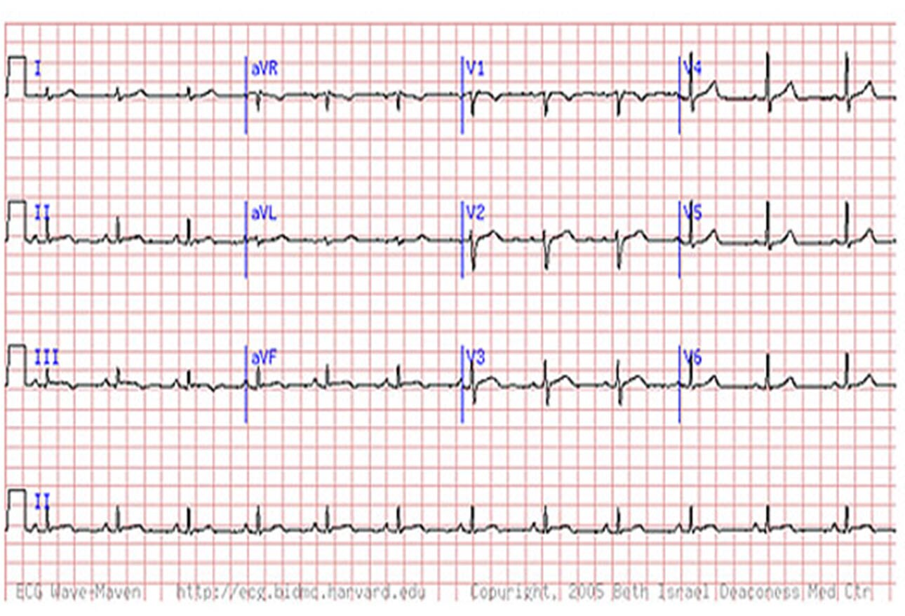 What is the ECG abnormality?