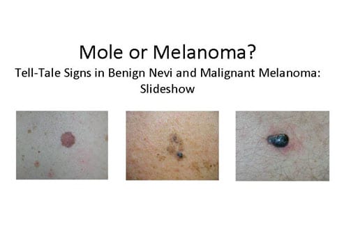 melanoma is through early