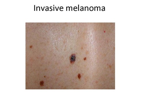 Mole or Melanoma?