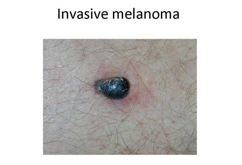 melanoma has an early