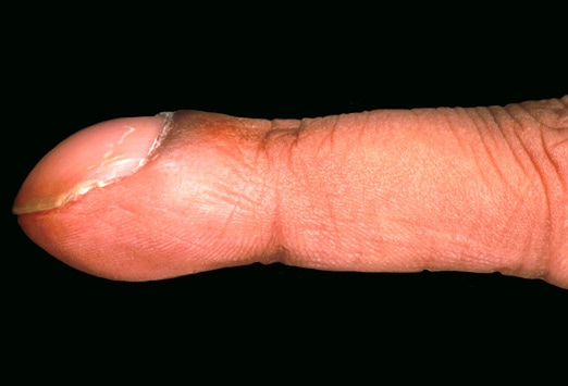  liver cirrhosis, achalasia), and skin (as exemplified by palmoplantar 