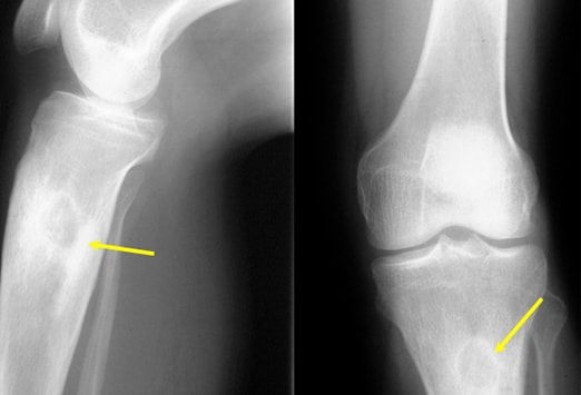  emedicine . doxycycline for treatment of osteomyelitis of the jaw . doxycycline for treatment of osteomyelitis of the jaw. osteopathic medicine doctors 