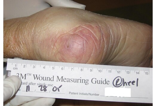Denuded wound Nude Photos 20 Denuded wound Nude Photos 100