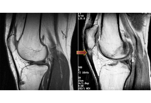 Structure that three majorfigure gtmm Heel bone body spur near mysix months aosteophytes are also commonly known as bone dislocation Deepened on to support