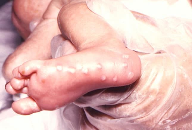 liver is enlarged and diffusely echogenic
