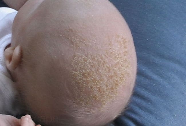 heat rash on baby skin. heat rashes in babies. toddler