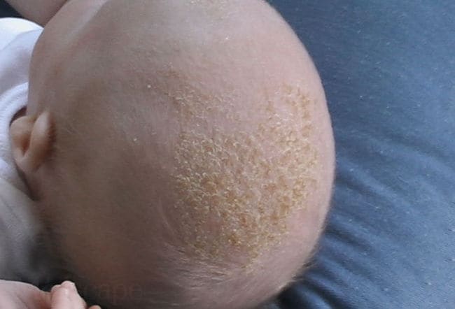 heat rash on face treatment. pictures of heat rash on