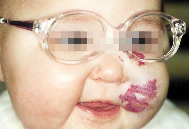 hemangioma on face. infantile hemangioma that