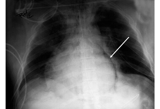 Broken Heart Syndrome: 12/1/10 - 1/1/11