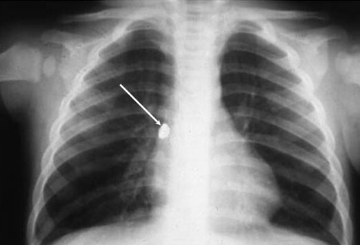 Can't Miss Critical Findings on Plain Chest Radiography